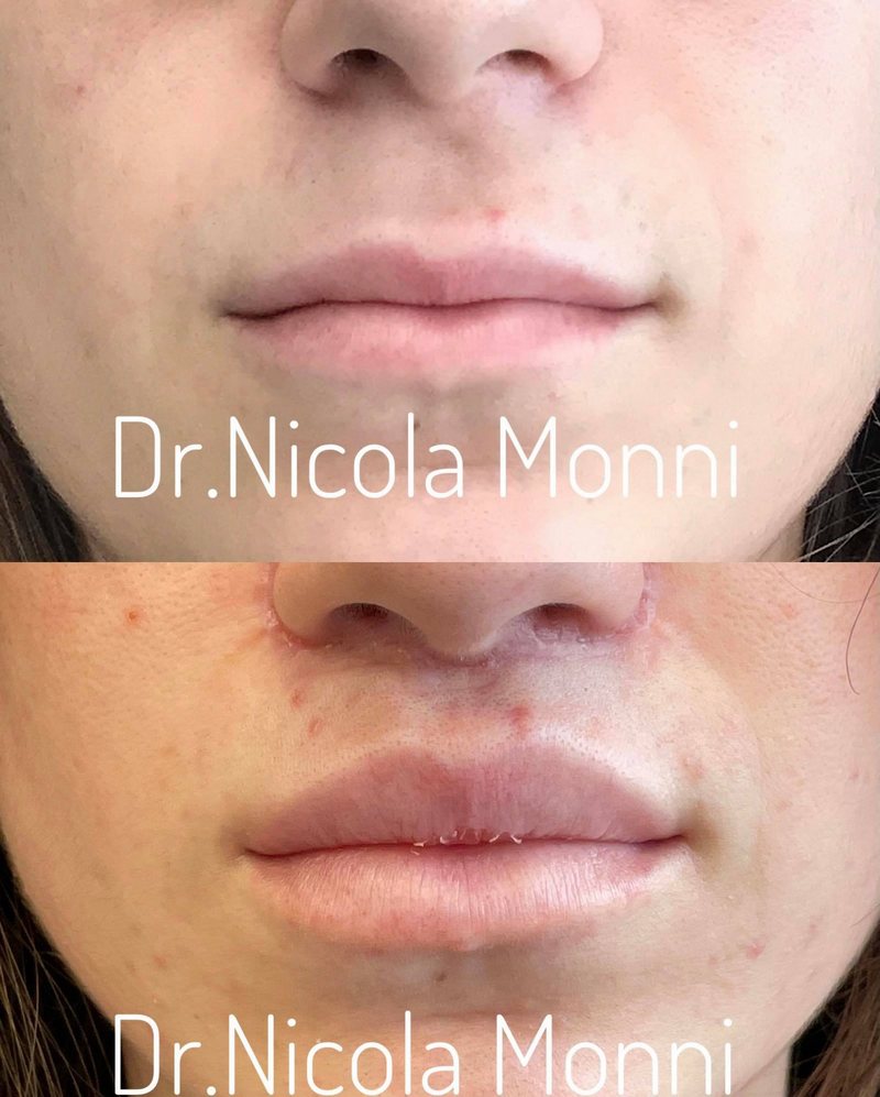 lip lift cagliari